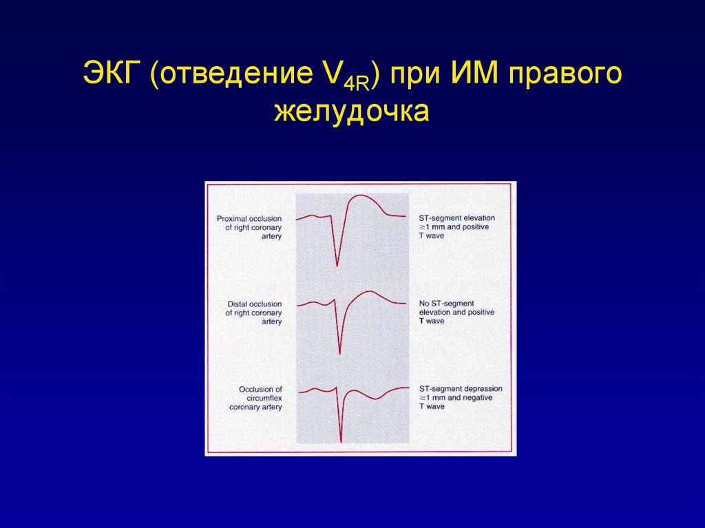 Экг на правую. Инфаркт миокарда правого желудочка на ЭКГ. Правый инфаркт миокарда на ЭКГ. Инфаркт правого желудочка отведения. Инфаркт миокарда правого желудочка ЭКГ отведения.