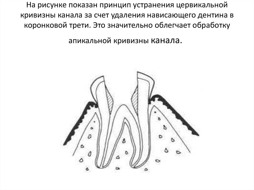 Устья корневых каналов схема