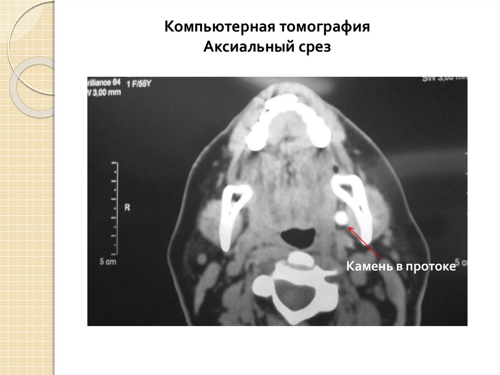 Сиалоаденит код