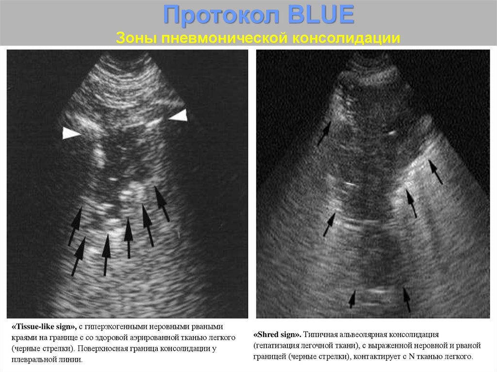 Узи легких. Консолидация легкого на УЗИ. Консолидация легочной ткани на УЗИ. УЗИ легких протокол. Зоны легких при УЗИ.