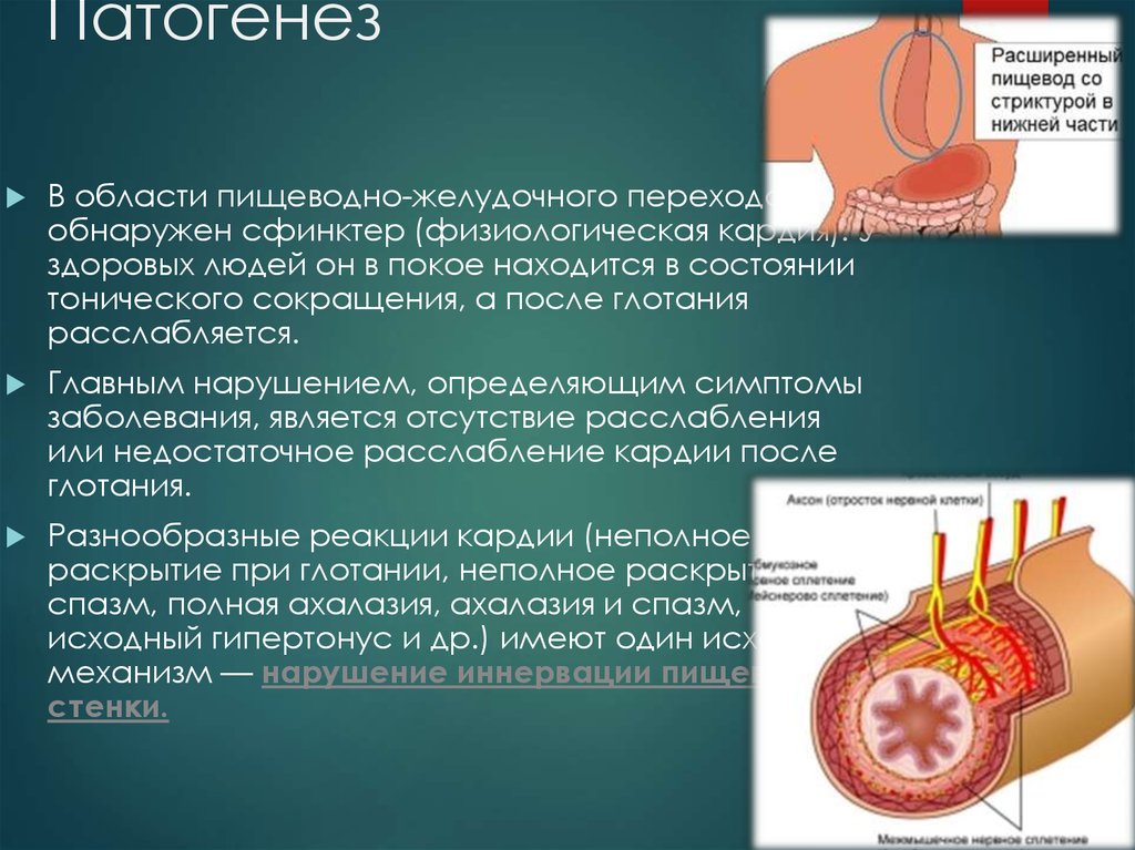 Ахалазия пищевода это