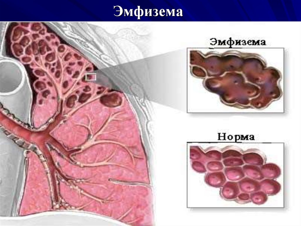 Презентация бронхиальная астма дипломная работа