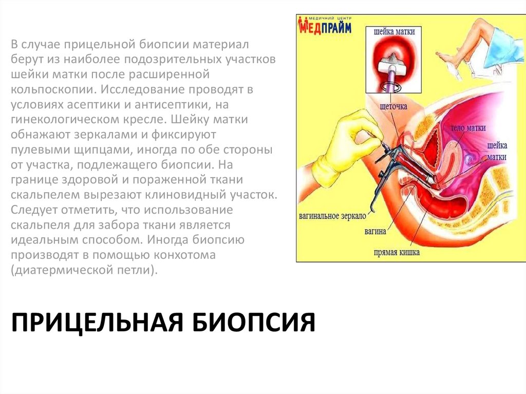 Биопсия матки. Инструменты для проведения прицельной биопсии шейки матки. Прицельная биопсия шейки матки. Прицельная биопсия инструменты. Техника прицельной биопсии шейки матки.