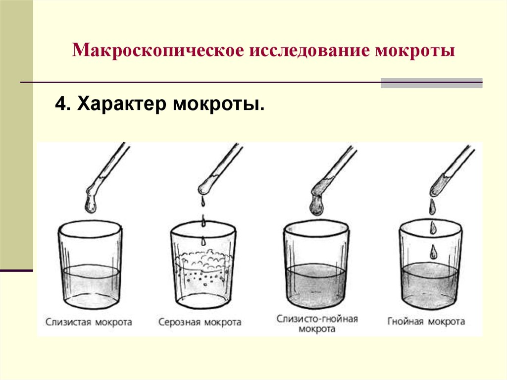 Что означает мокрота. Исследование мокроты пропедевтика. Анализ мокроты пропедевтика внутренних. Исследование мокроты ПВБ. Исследование мокроты при пневмонии.