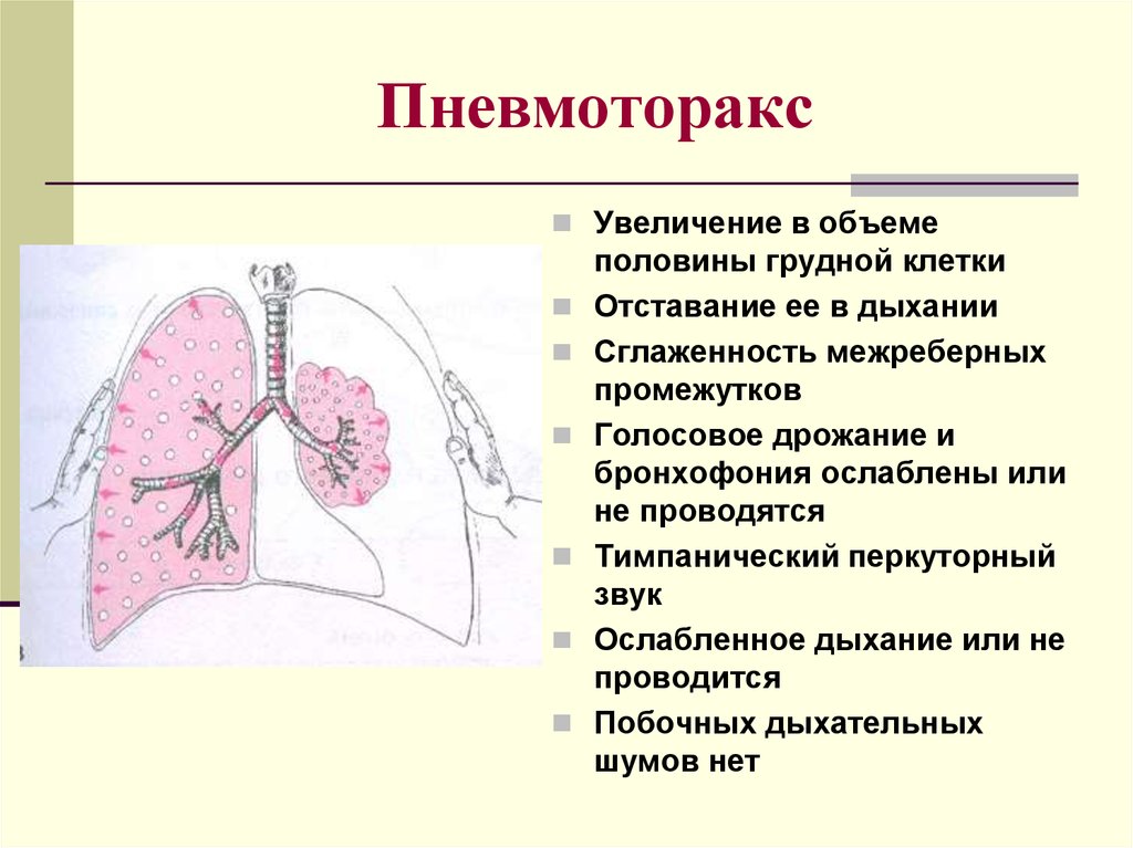 Резистентность грудной. Спонтанный пневмоторакс факторы риска. При пневмотораксе у взрослого объем грудной клетки:. Пневмоторакс физиология дыхания. Спонтанный пневмоторакс пропедевтика.