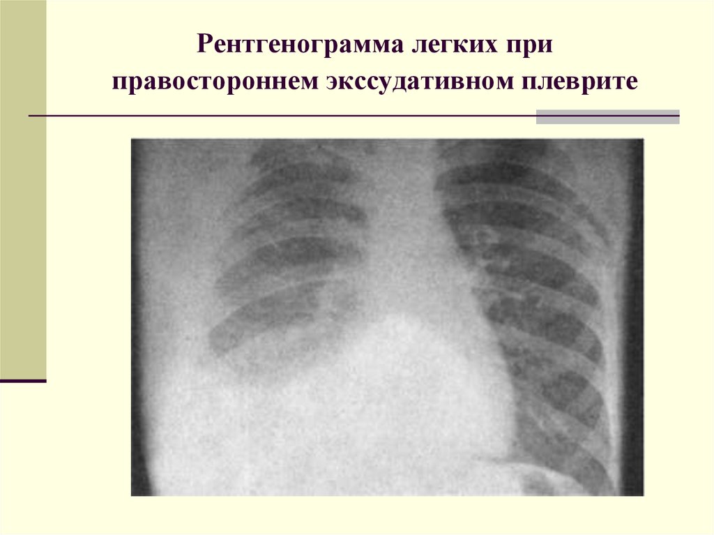 Рентгенограмма легких при правостороннем экссудативном плеврите