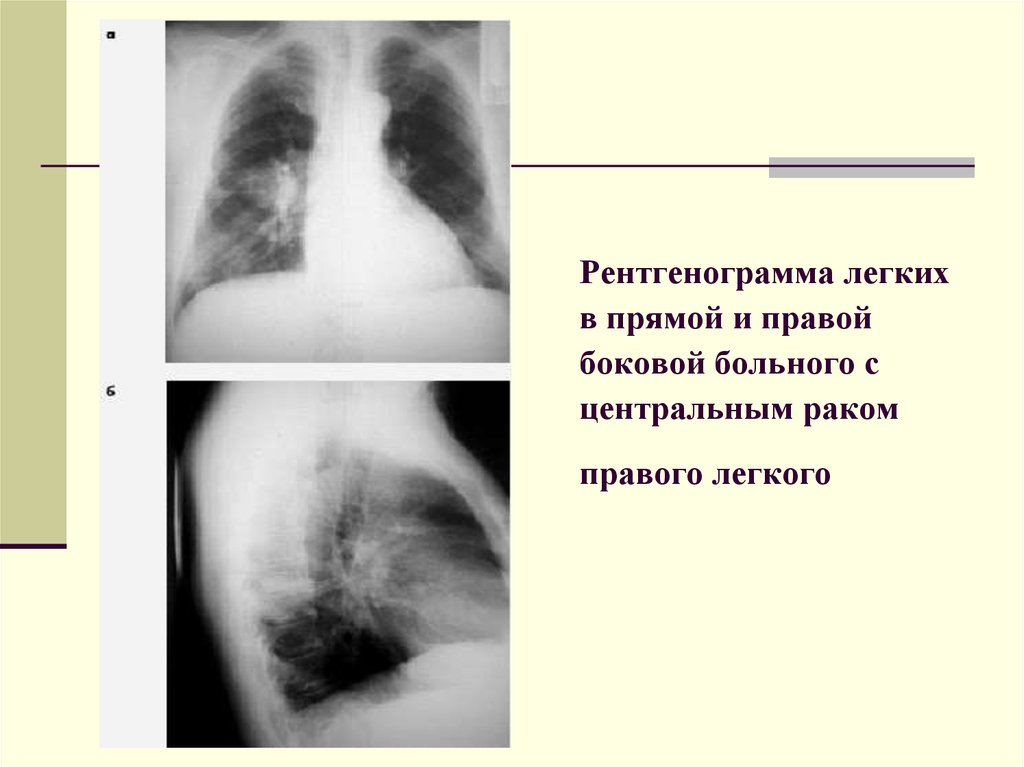 Рентгенограмма легких в прямой и правой боковой больного с центральным раком правого легкого