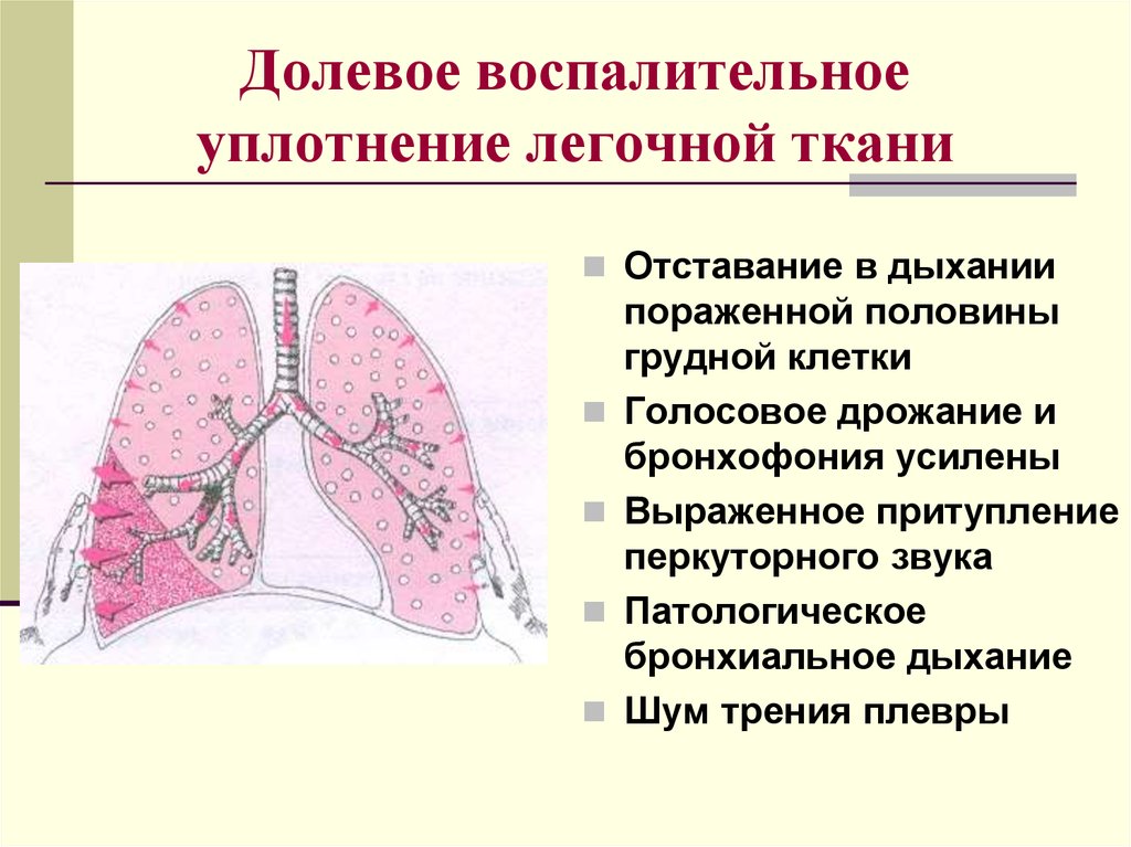 Бронхиальное дыхание звук. Синдром долевого уплотнения легочной ткани. Синдром уплотнения легочной ткани рентген. Синдром долевого уплотнения легочной ткани рентген. Синдром воспалительного уплотнения легочной ткани пропедевтика.