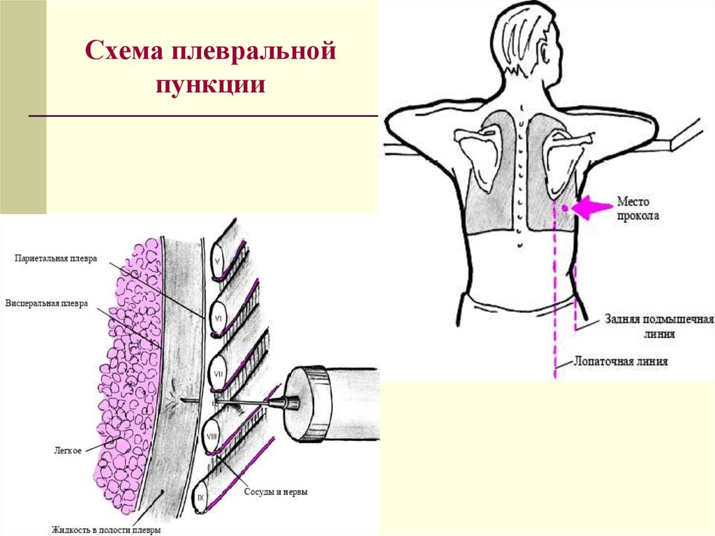 Плевральная пункция. Пункция плевральной полости техника межреберье. Точка пункции плевральной полости при пневмотораксе. Показания к пункции плевральной полости. Плевральная пункция схема.