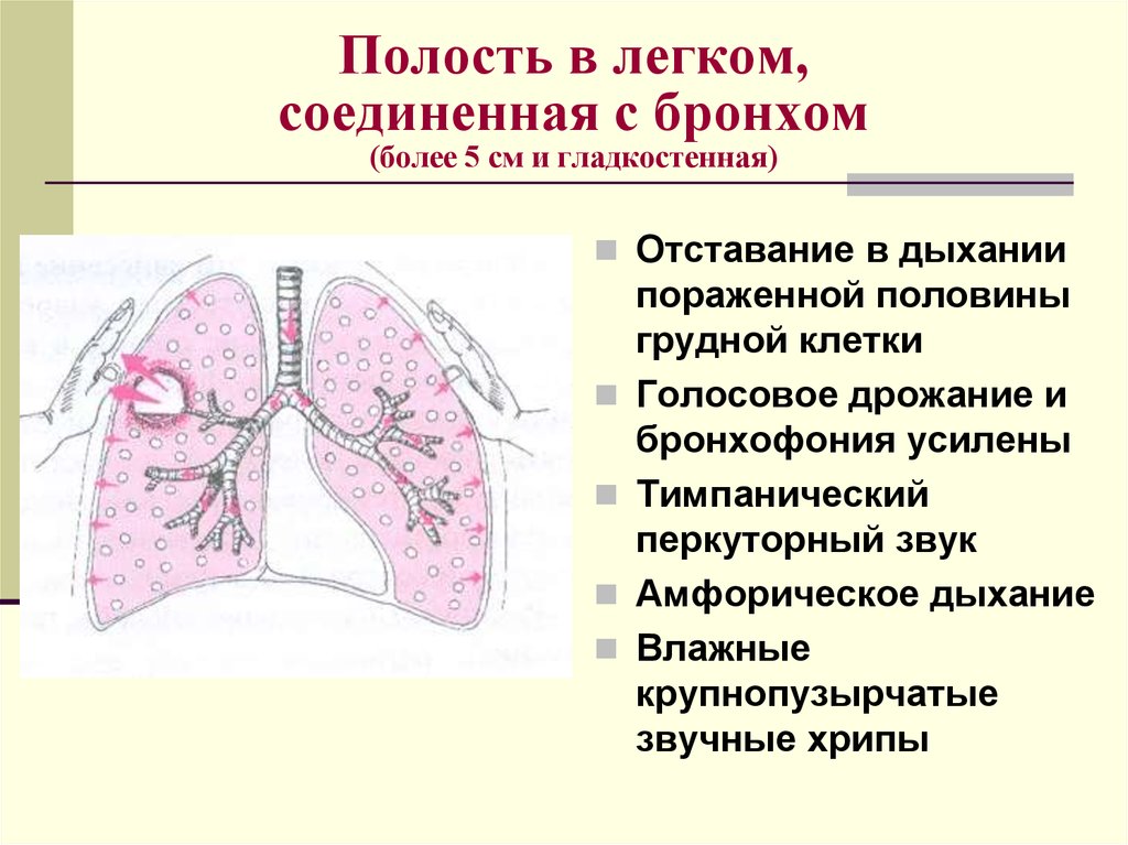 Наличие полости. Синдром полости сообщающейся с бронхом. Полость в легком сообщающаяся с бронхом. Полость в легком соединенная с бронхом.