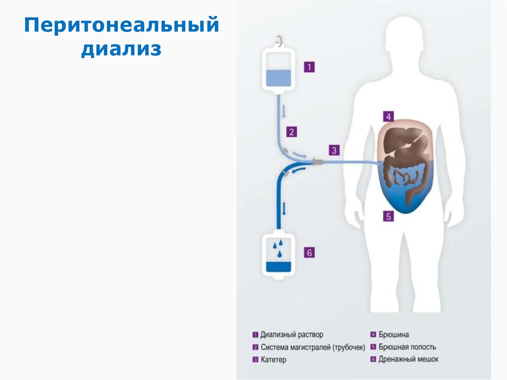 Перитонеальный диализ. Перитонеальный диализ ПАПД. Схема проведения перитонеального диализа. Перитонеальный диализ брюшина. Автоматизированный перитонеальный диализ техника проведения.