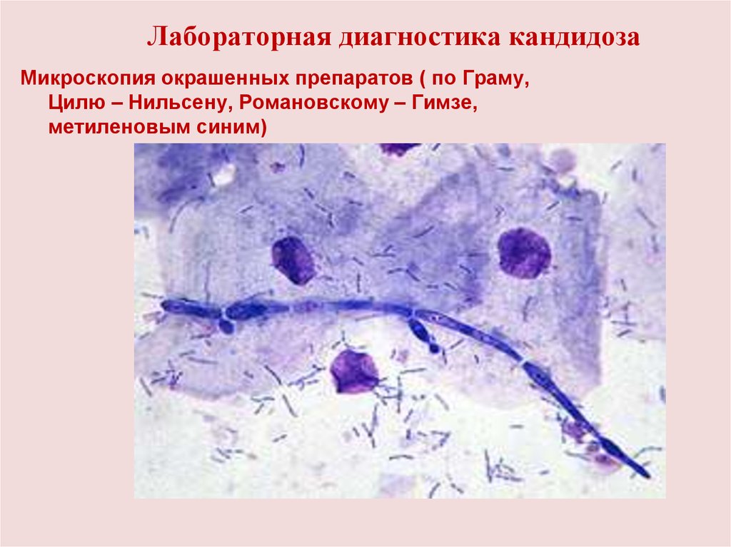 Трихомониаз диагностика