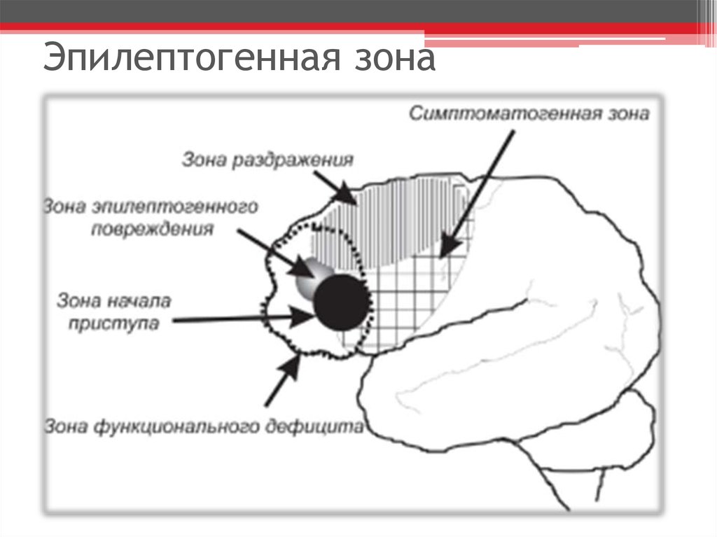 Зона представляет. Эпилептогенная зона. Эпилептогенный очаг. Селективная резекция эпилептогенной зоны. Субтотальная резекция эпилептогенной зоны головного мозга.