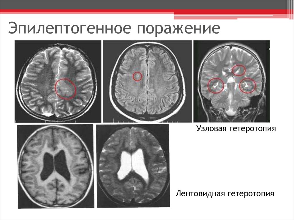 Гетеротопия. Гетеротопия серого вещества. Субэпендимальная гетеротопия серого вещества головного мозга. Узловая гетеротопия серого вещества.