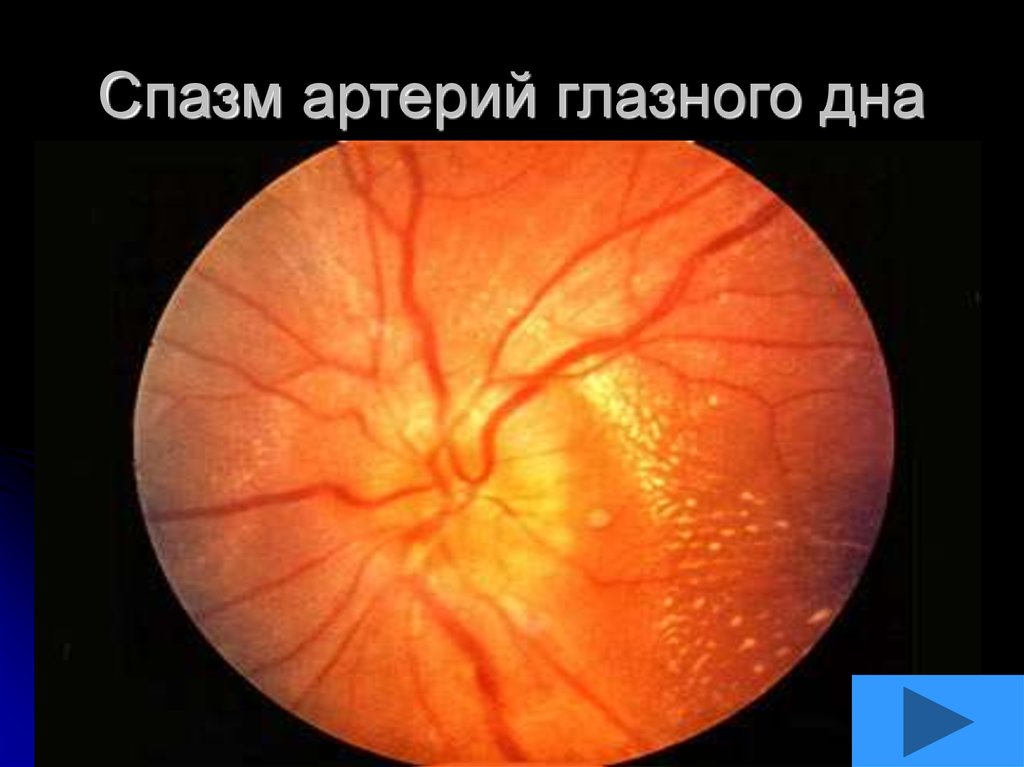 Гипертоническая ангиопатия обоих глаз. Проминенция зрительного нерва. Атрофия зрительного нерва глазное дно. Проминирует диск зрительного нерва.
