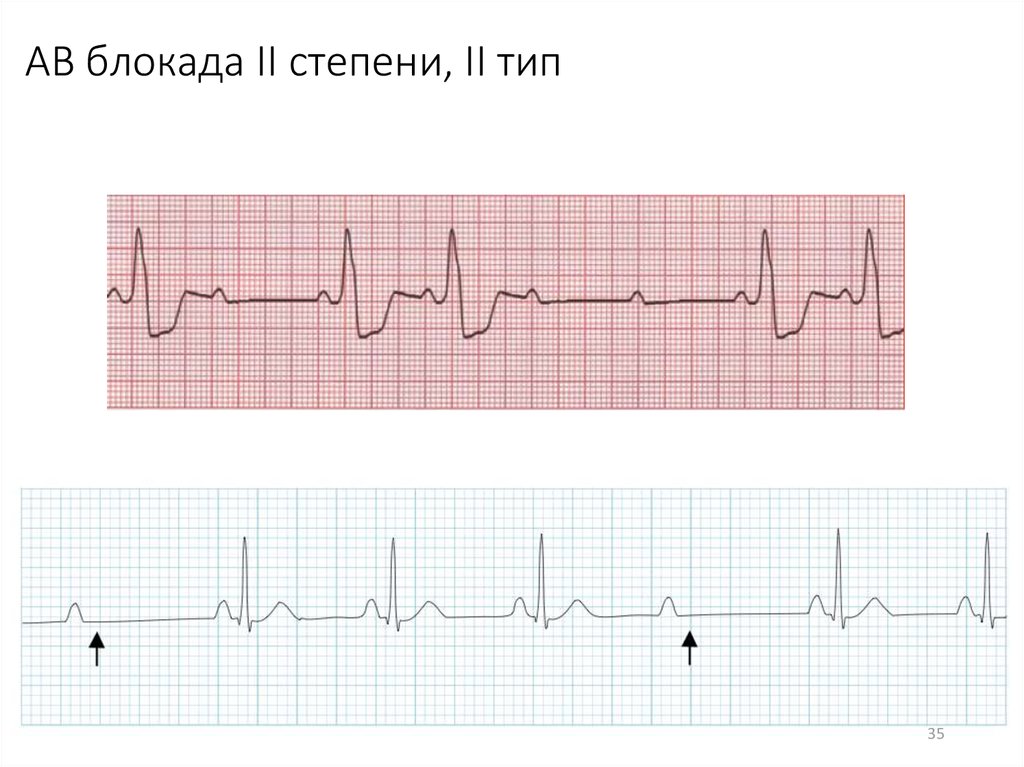 Брадиаритмия у ребенка. Брадиаритмия на ЭКГ. АВ-блокада 2 степени 2 типа у детей. АВ блокада 1 степени у спортсменов. Синусовая брадиаритмия на ЭКГ.