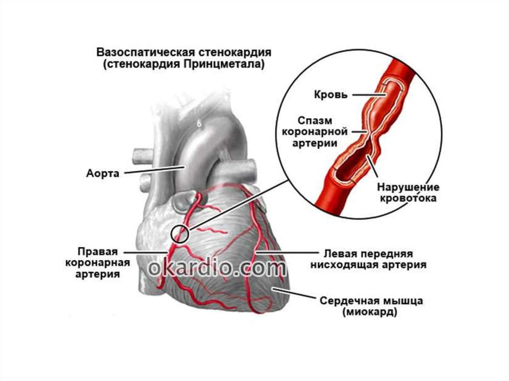 Почему спазм сосудов. ИБС вазоспастическая стенокардия. Спонтанная (вариантная) стенокардия. ИБС вариантная стенокардия Принцметала. Механизм развития стенокардии Принцметала.