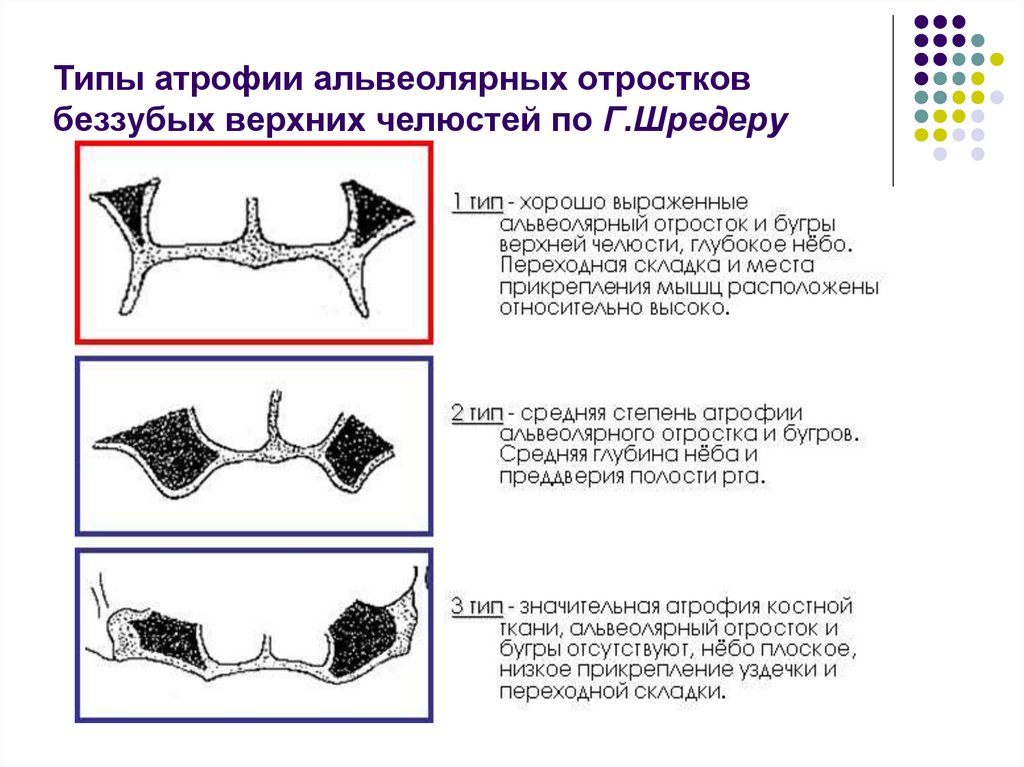 Атрофия альвеолярного отростка нижней челюсти. Классификация атрофии беззубых челюстей Шредера. Классификация Шредера атрофия альвеолярного отростка. Альвеолярный отросток верхней челюсти классификация. Классификация беззубой верхней челюсти по Шредеру.