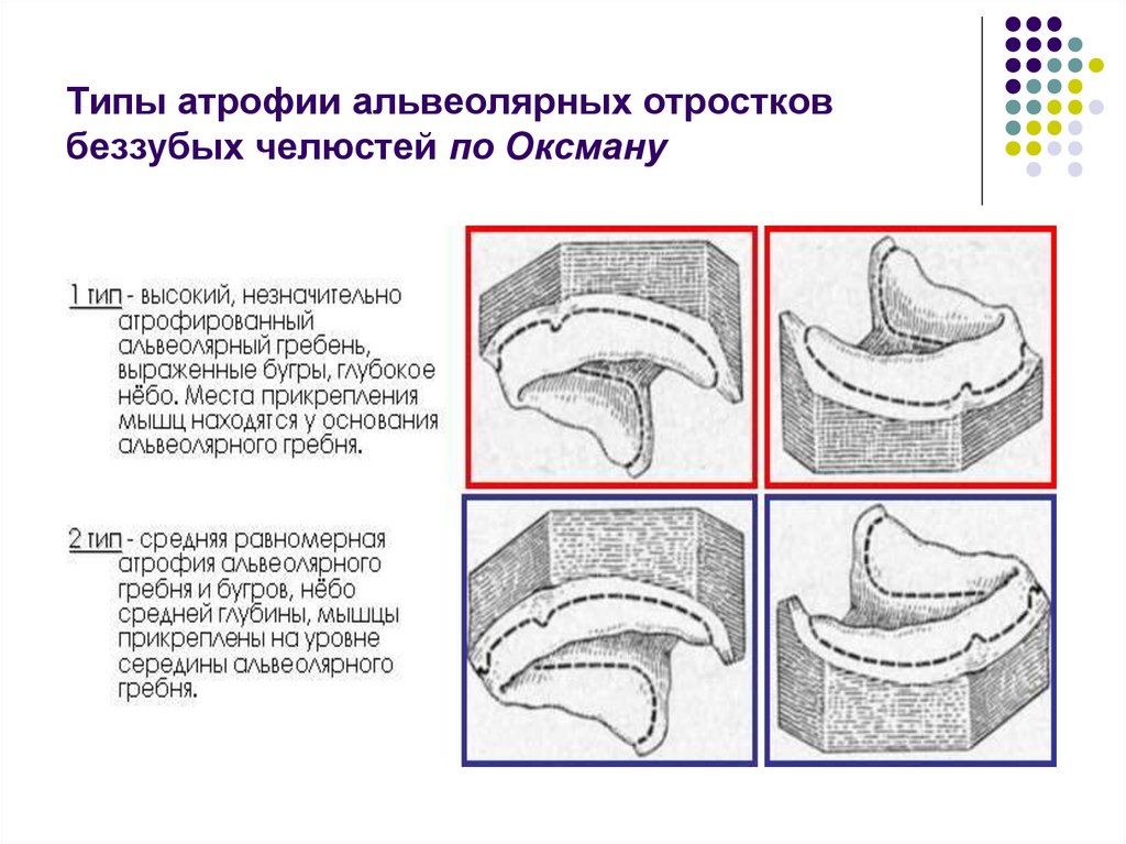 Зона податливости слизистой оболочки. Классификация по Оксману нижняя челюсть. Типы атрофии альвеолярного отростка. Оксман классификация беззубых челюстей. Атрофия альвеолярного отростка классификация.