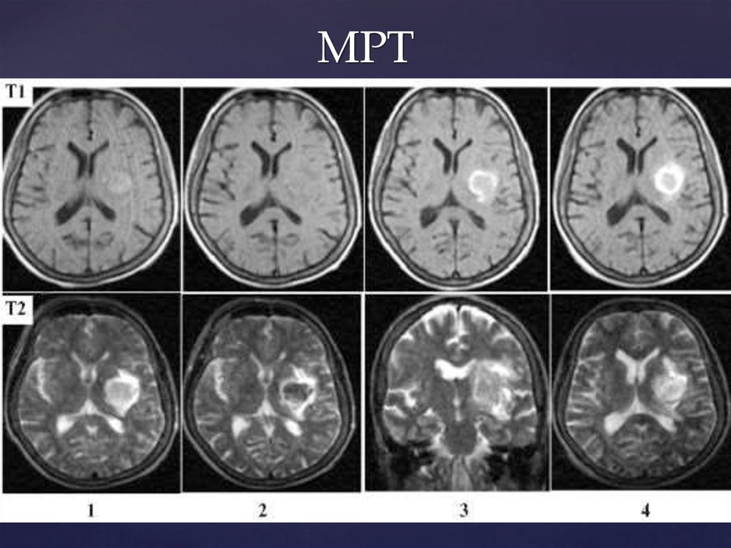 Изменение мрт. Мрт ишемический инсульт т1. Геморрагический инсульт мрт т1 т2. Стадии ишемического инсульта на кт. Геморрагический инсульт кт и мрт.