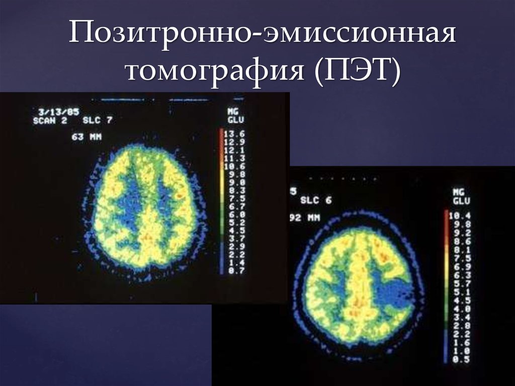 Позитронно эмиссионная томография. Позитронно-эмиссионная томография презентация. Позитронно-эмиссионная томография сердца. Позитронная эмиссионная томография ПЭТ презентация.