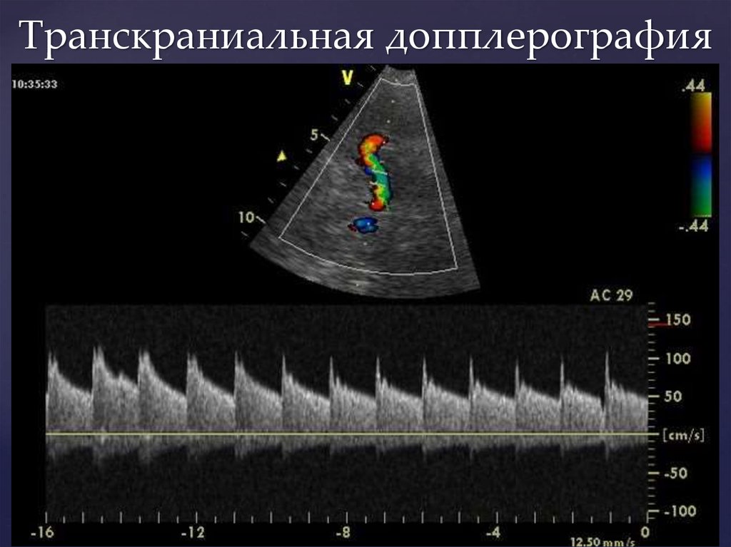 Допплерография ребенку. Транскраниальная ультразвуковая допплерография. Транскраниальная ультразвуковая допплерография сосудов головного. Транскраниальный датчик УЗИ.