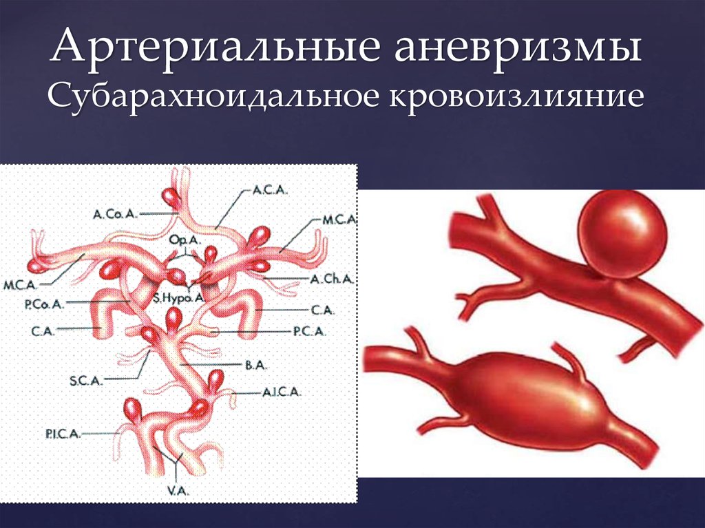 Аневризма. Артериальная аневризма. Артериальные аневризмы. Артериальная аневризма головного мозга.