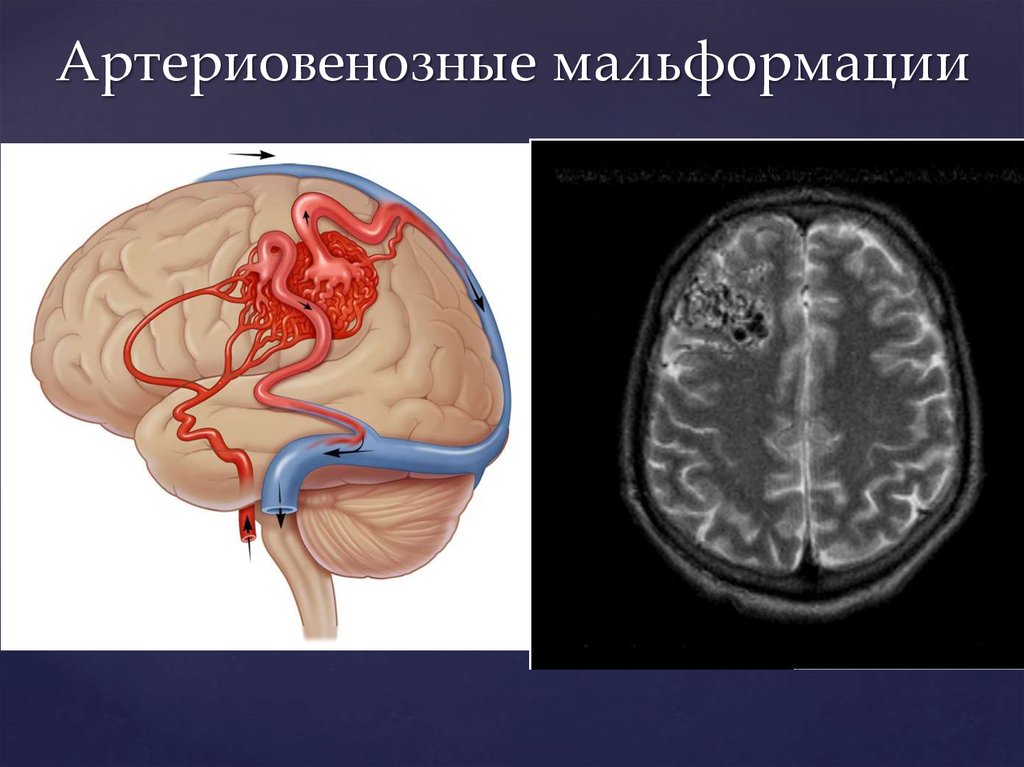 Сосудистые мальформации головного. Артериовенозные мальформации сосудов головного мозга. АВМ сосудов головного мозга. Артериовенозная мальформация (АВМ). Венозная мальформация головного мозга.