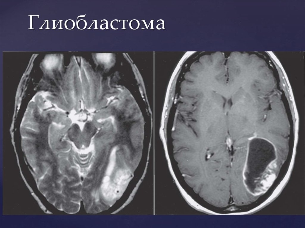 Глиобластома у женщины. Глиобластома головного мозга 4 степени. Мультиформная глиобластома. Мультиформная глиобластома мрт.