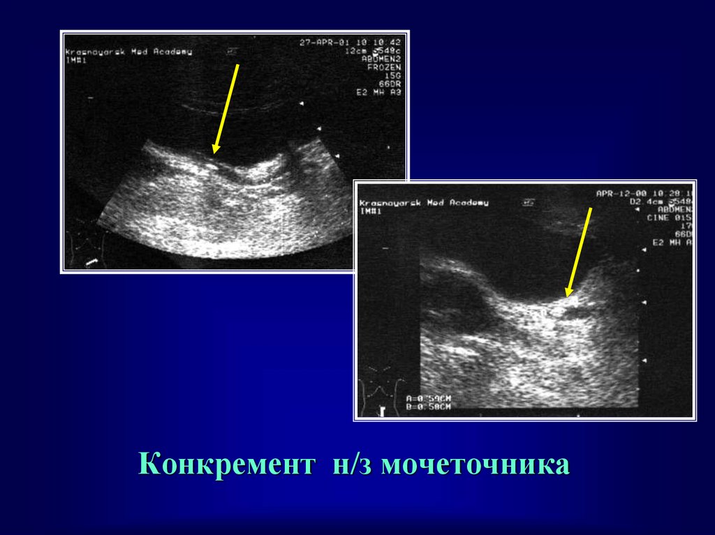 Узи картина мочекаменной болезни