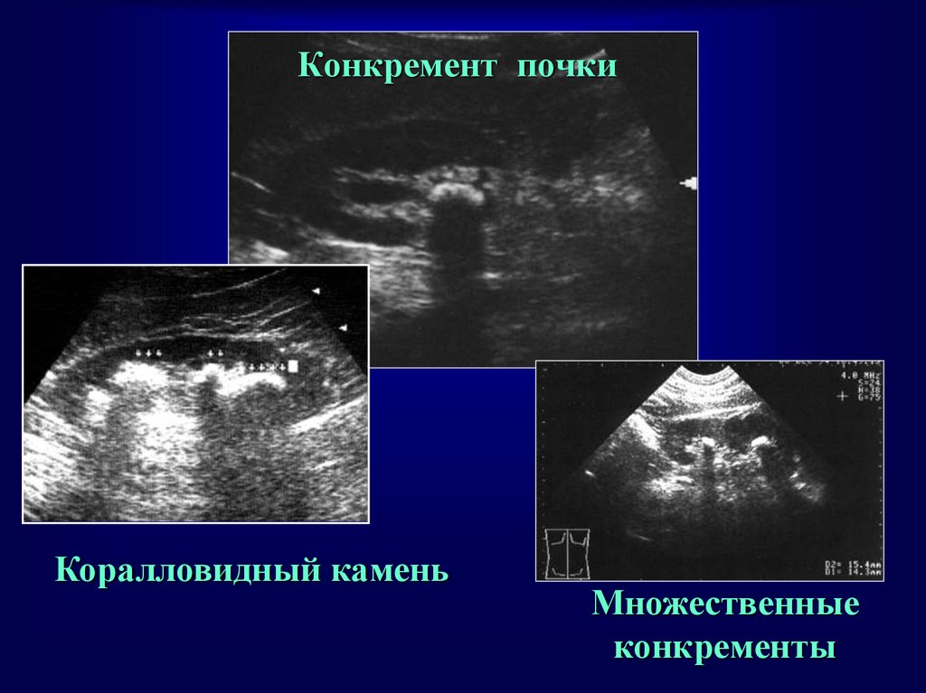 Размеры конкрементов почек. Коралловидный камень в почке УЗИ. Коралловидный конкремент почки УЗИ. Конкременты в почках на УЗИ что это такое. Мелкие конкременты в почках.