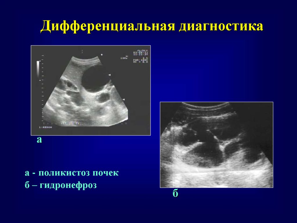 Поликистоз почек на узи. УЗИ почек гидронефроз 1ст. Поликистоз почек дифференциальный диагноз. Поликистоз почек УЗИ диагностика. Гидронефроз на УЗИ степени.