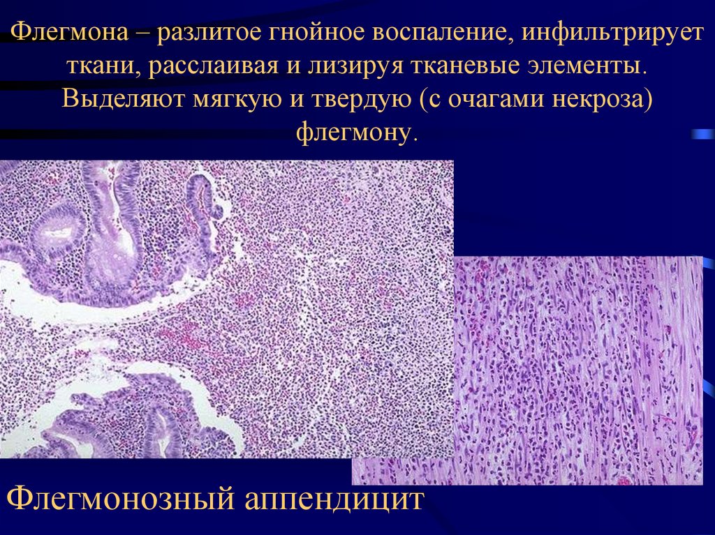 Аппендицит микропрепарат. Флегмонозный аппендицит патологическая анатомия. Флегмона кожи патанатомия. Флегмона подкожной клетчатки патанатомия. Флегмонамягуких тканей препарат.