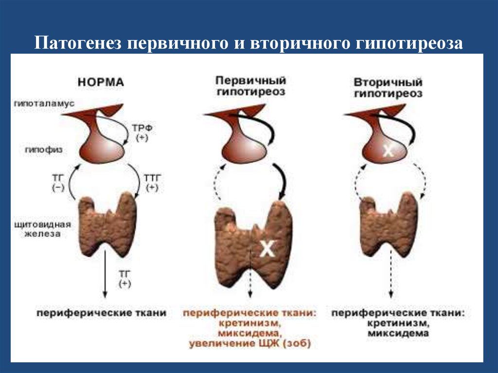 Врожденный гипотиреоз у детей презентация