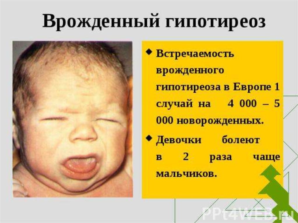 Врожденный гипотиреоз у детей презентация