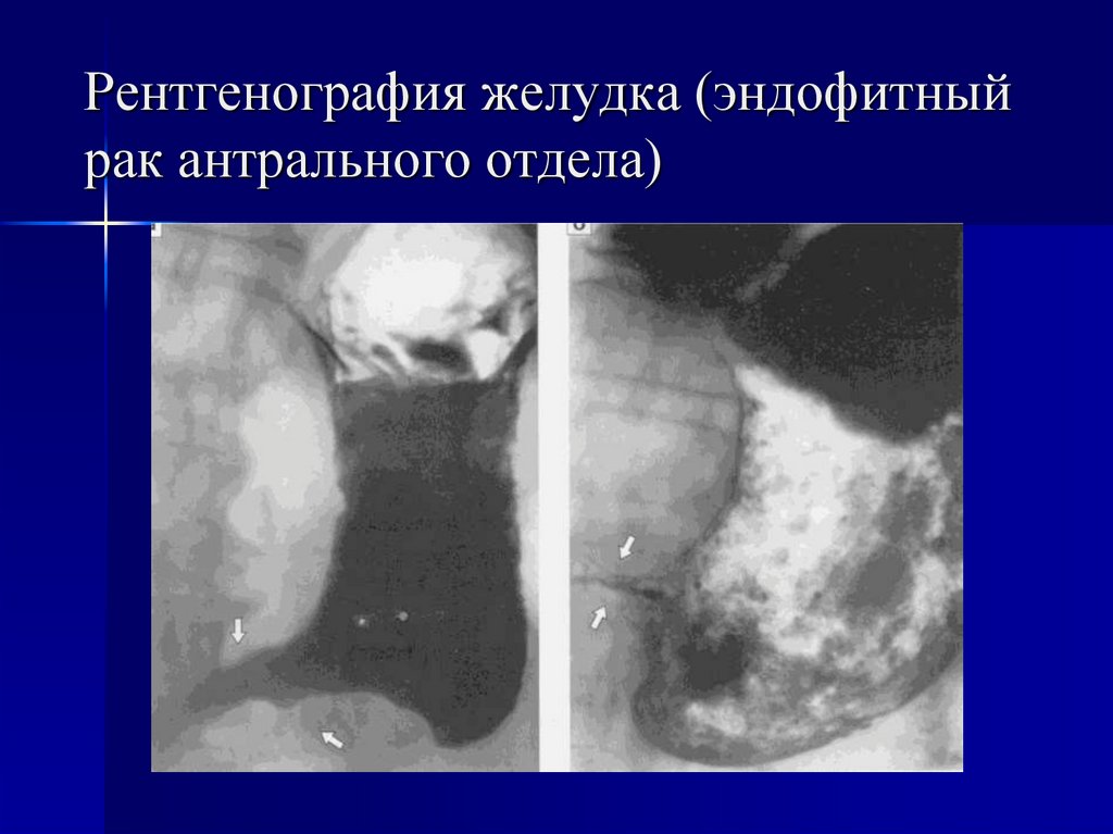 Рентгенография желудка (эндофитный рак антрального отдела)