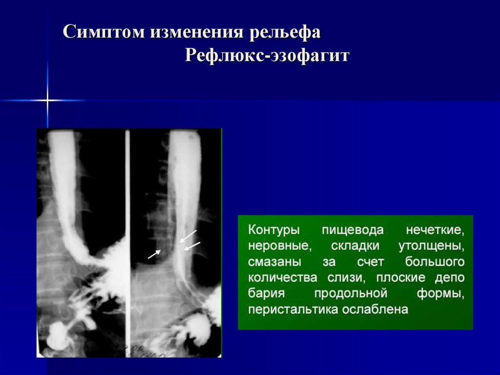 Лучевая диагностика пищевода презентация