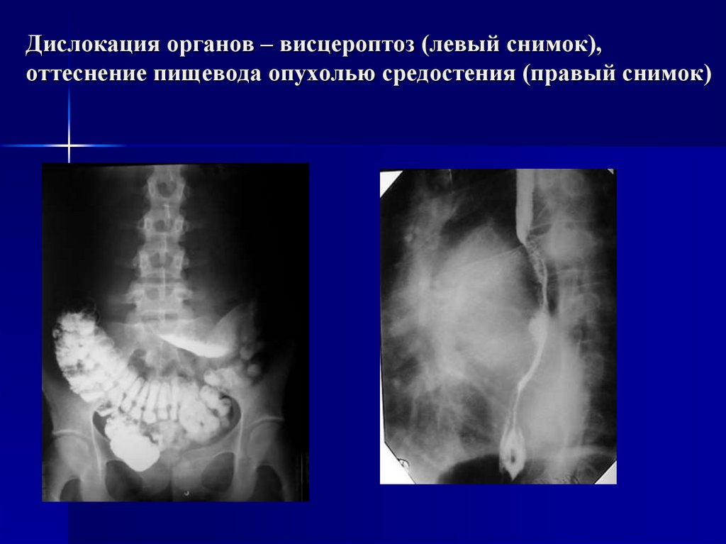 Дислокация органов – висцероптоз (левый снимок), оттеснение пищевода опухолью средостения (правый снимок)
