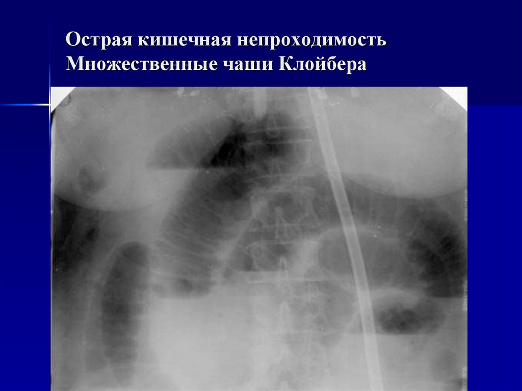 Острая кишечная непроходимость. Кишечная непроходимость чаши Клойбера. Кишечная непроходимость рентген чаши Клойбера. Механическая кишечная непроходимость чаши Клойбера. Рентген кишечника чаши Клойбера.