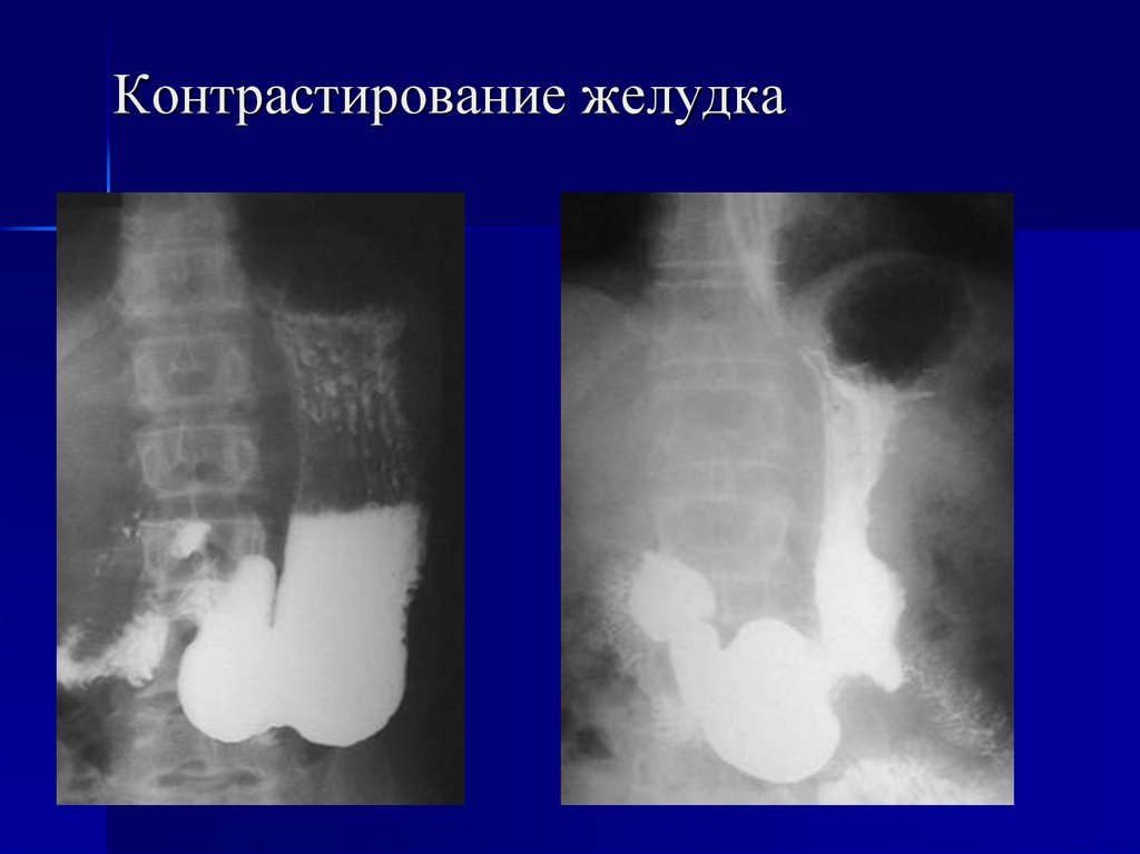 Рентген желудка. Контрастирование желудка рентген. Двойное контрастирование желудка рентген. Патологии желудка на рентгеноскопии. Рентгеноскопия желудка с барием норма.