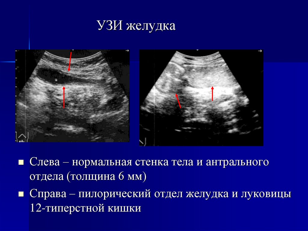 Как выглядит рак желудка на узи фото у мужчин