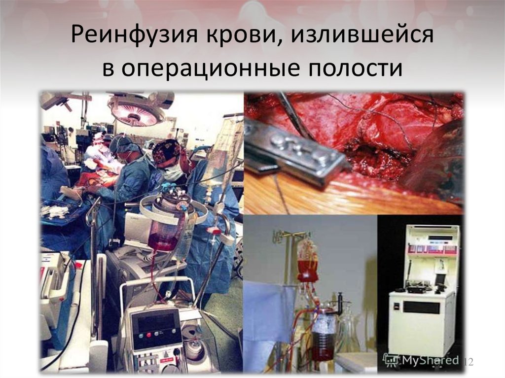 Реинфузия крови, излившейся в операционные полости