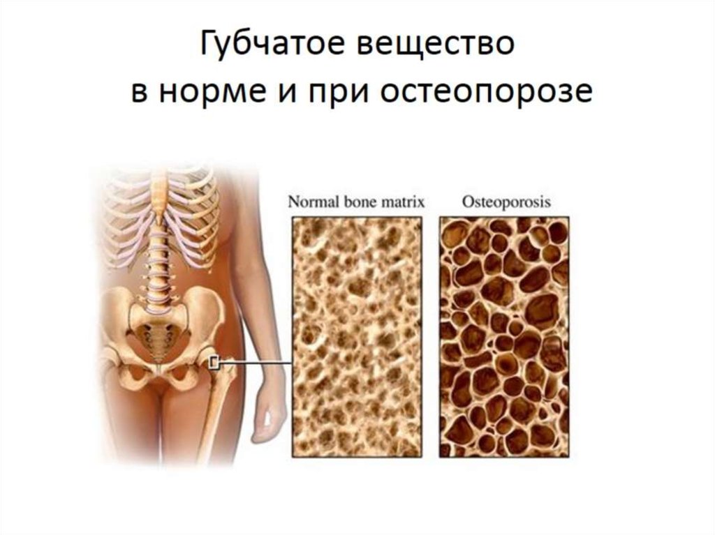 Губчатое вещество в норме и при остеопорозе