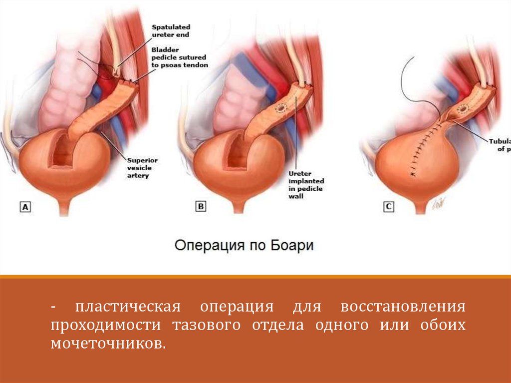 Операция тома. Уретероцистоанастомоз по Боари. Уретероцистонеостомия по Боари.