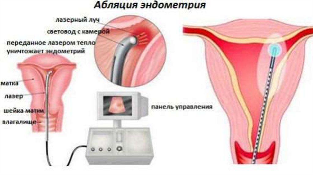 Удаление матки при гиперплазии. Лазерная абляция эндометрия. Гинекология гиперплазия эндометрия. Абляция эндометрия при гиперплазии. Абляция эндометрия гистероскопическая.