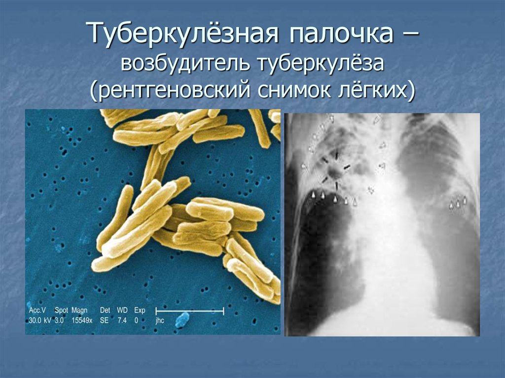 Туберкулезная палочка биология. Микобактерия туберкулеза палочка Коха. Mycobacterium tuberculosis строение. Палочка Коха туберкулез. Палочка Коха возбудитель туберкулеза.