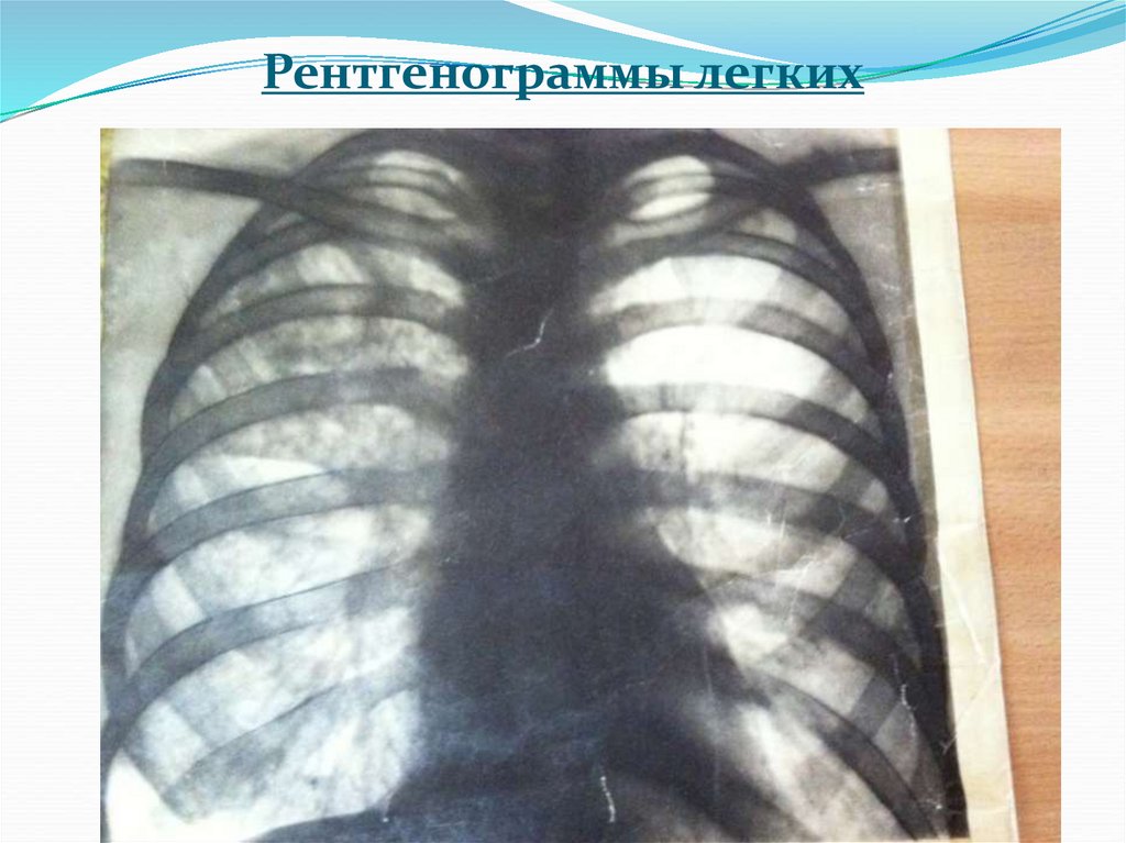 Рентгенограммы легких