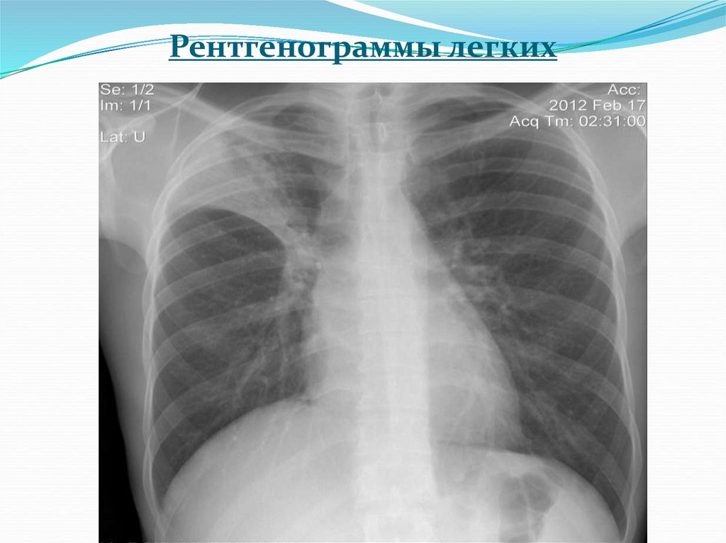 Рентгенограммы легких