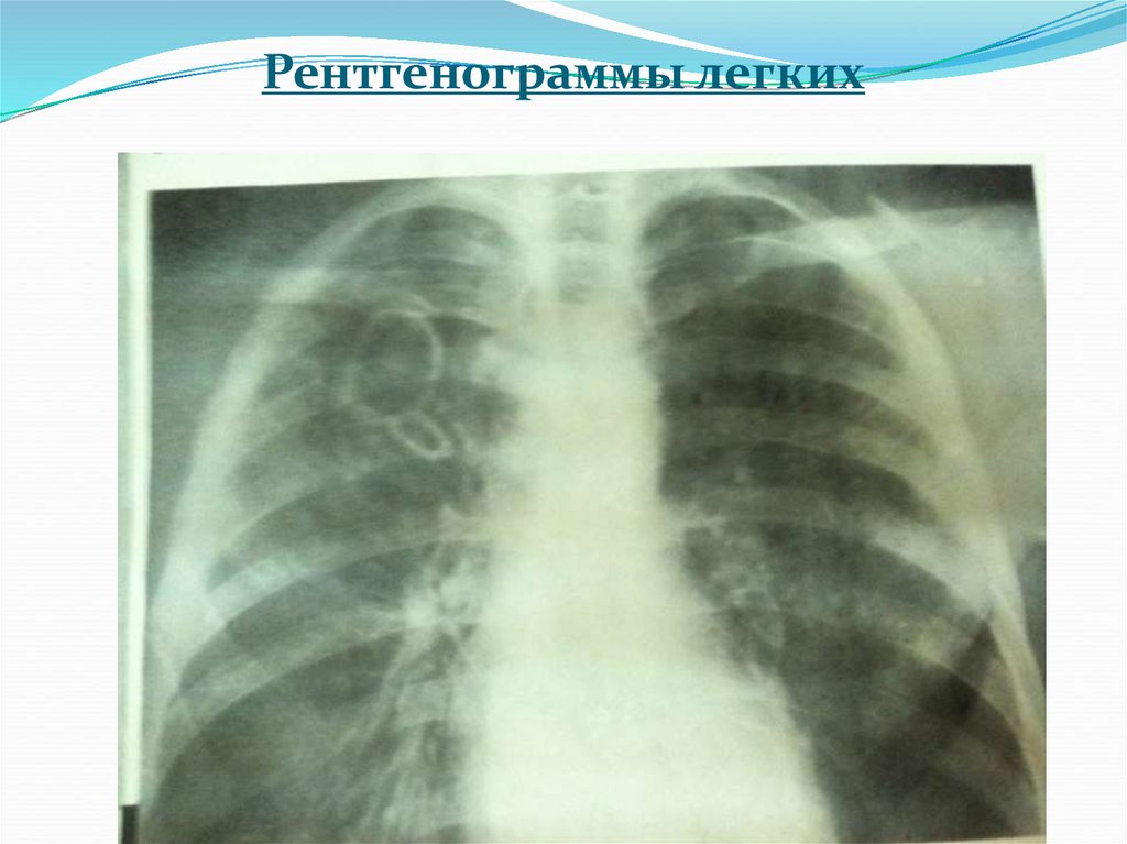 Диагностика легких. Отсутствие легкого на рентгенограмме. Рентгенография легких презентация. Лучевая диагностика легких Здоровые легкие. Рентгенография легких диагностическая ценность.