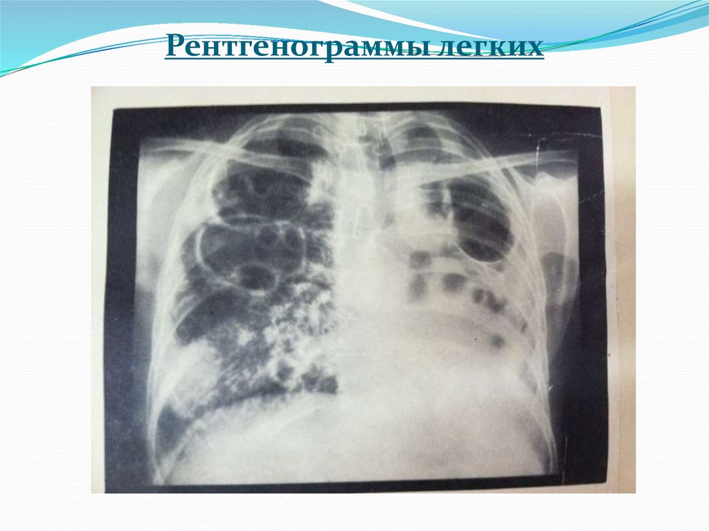 Рентгенограммы легких